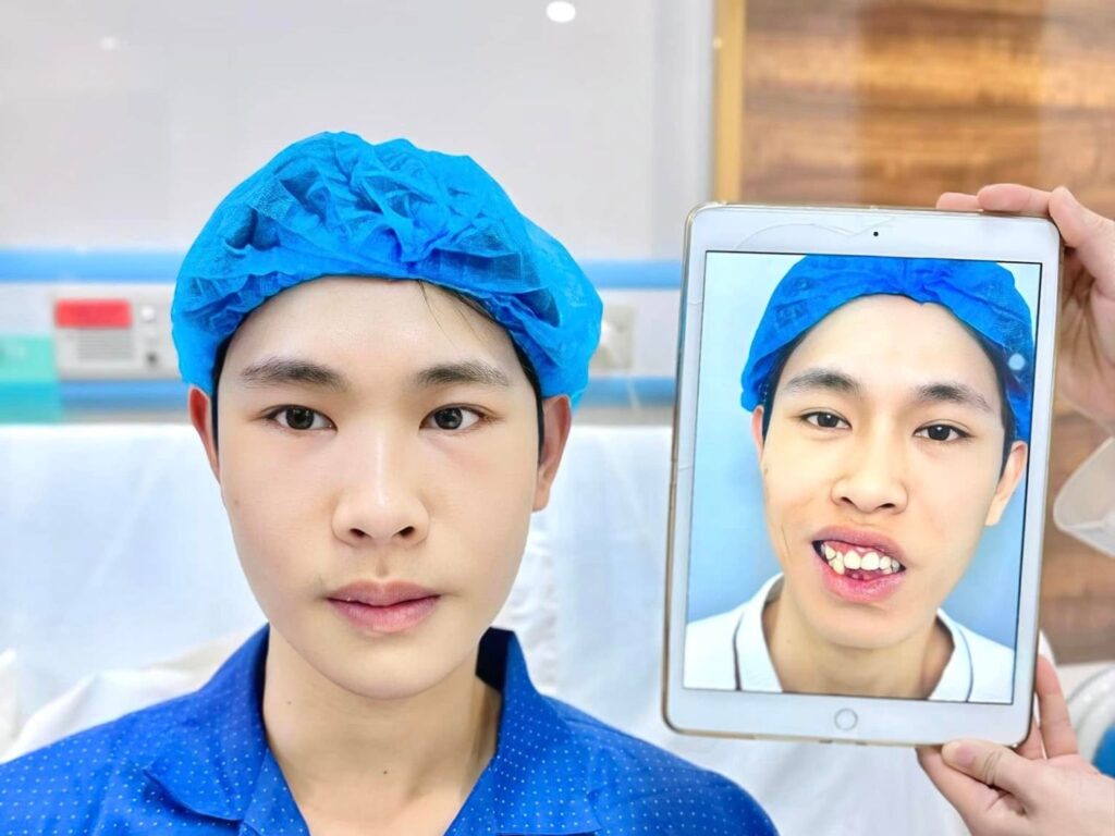 Chỉnh cả 2 hàm cải thiện khuôn mặt