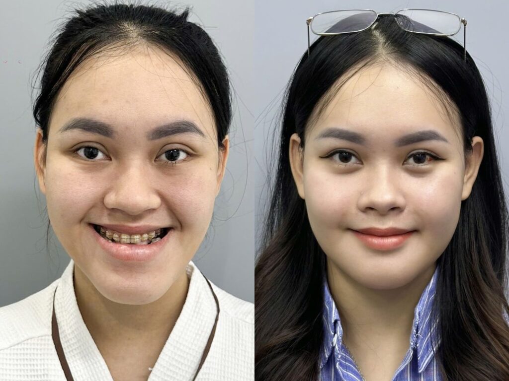 Người có vấn đề răng miệng cần phẫu thuật chỉnh hàm