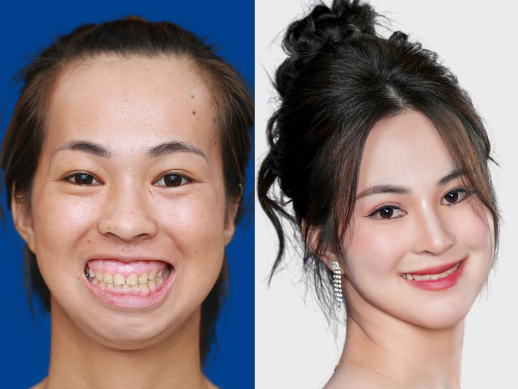 Xu hướng chỉnh hàm đẹp, thẩm mỹ tại Việt Nam