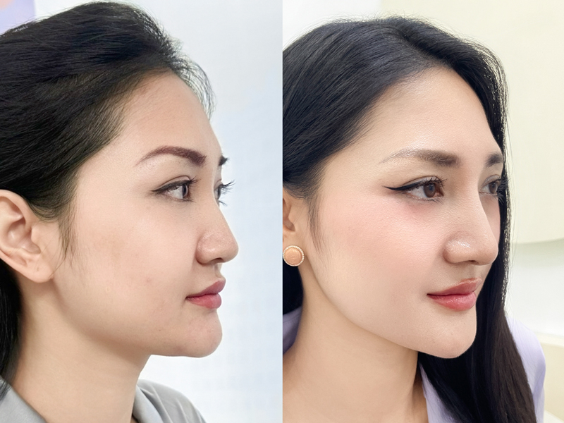 Mũi thẳng S-line sau nâng, bảo hành lâu dài