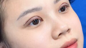 Các phương pháp thẩm mỹ mắt phổ biến hiện nay