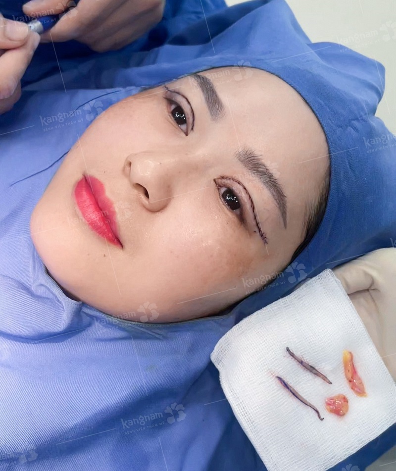 Cắt mí loại bỏ da thừa, mỡ dư và định hình lại nếp mí mới