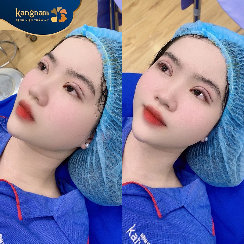 Thẩm mỹ cắt mí mang lại hiệu quả lâu dài