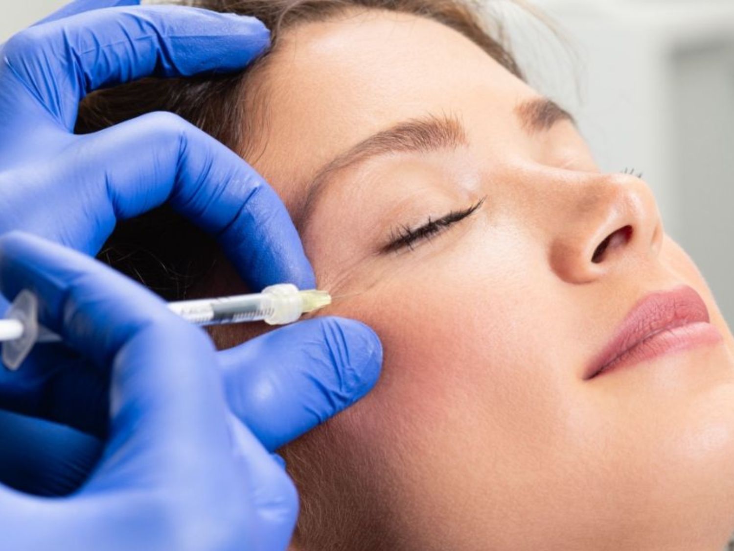 Tiêm xóa nhăn quanh vùng mắt