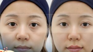 Cách cải thiện mắt không phẫu thuật: Có hiệu quả không?