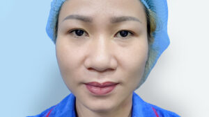 Cánh Mũi To Là Gì? 2 Nguyên Nhân Và 6 Cách Khắc Phục Phổ Biến