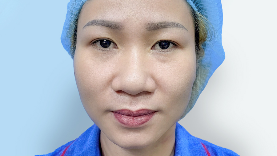 Cánh Mũi To Là Gì? 2 Nguyên Nhân Và 6 Cách Khắc Phục Phổ Biến