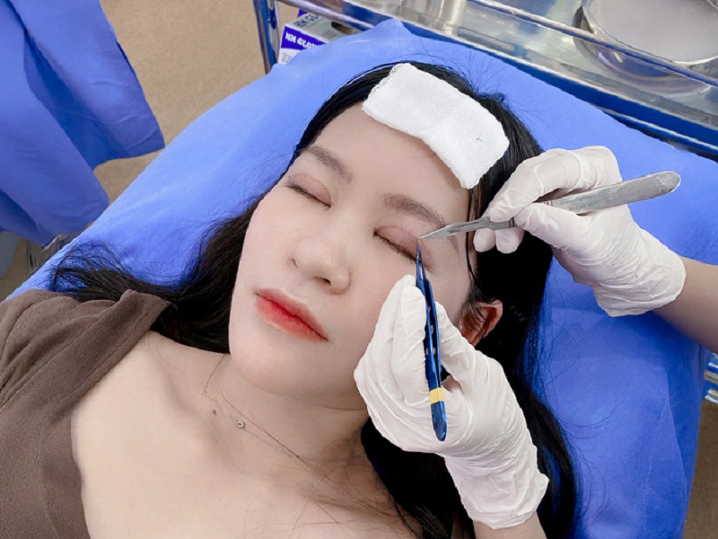 Cắt mí sau 7 ngày liền da và thực hiện cắt chỉ giúp nếp mí bắt đầu vào nếp.