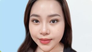 Cắt mí bao lâu thì hồi phục? Thời gian lành, hết sưng và sinh hoạt bình thường