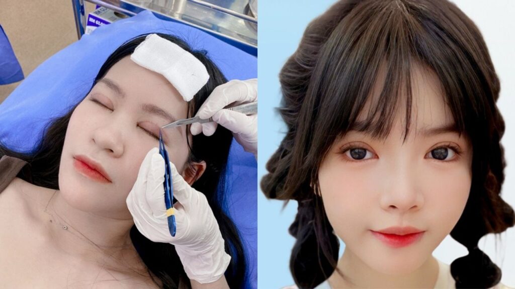 Cắt mí bao lâu thì ổn định? Timeline hồi phục từng giai đoạn từ chuyên gia