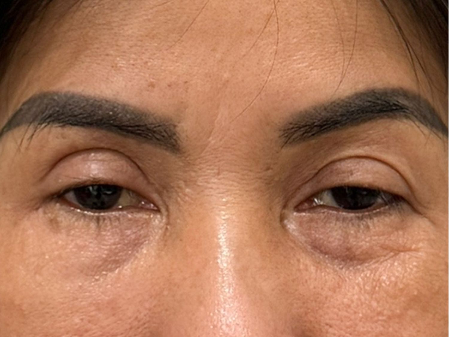 tình trạng mí quá sâu khiến đối mắt trông mất tự nhiên do bác sĩ cắt mí quá cao