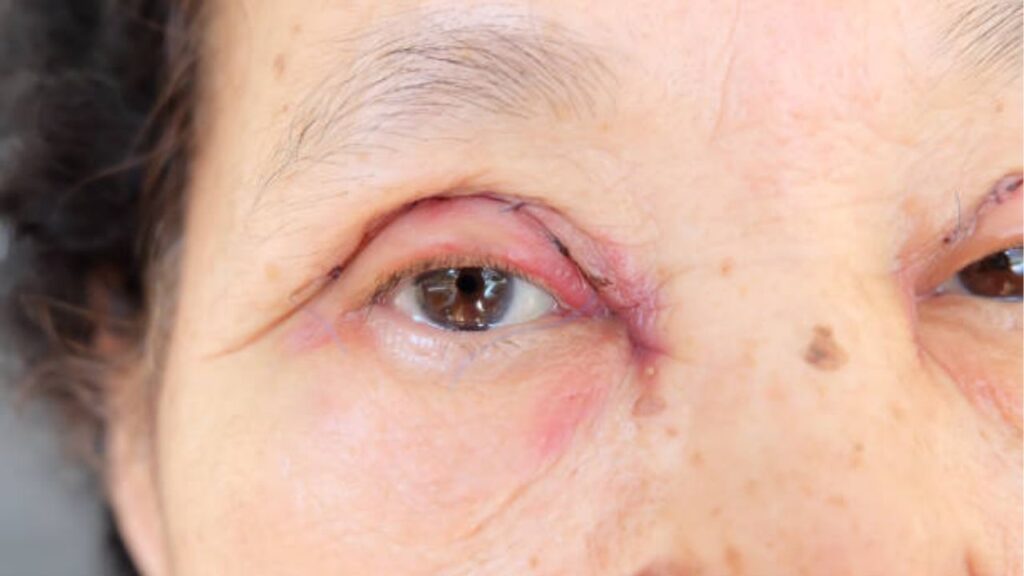 Cắt mí hỏng là gì? Dấu hiệu nhận biết, nguyên nhân và hướng xử lý