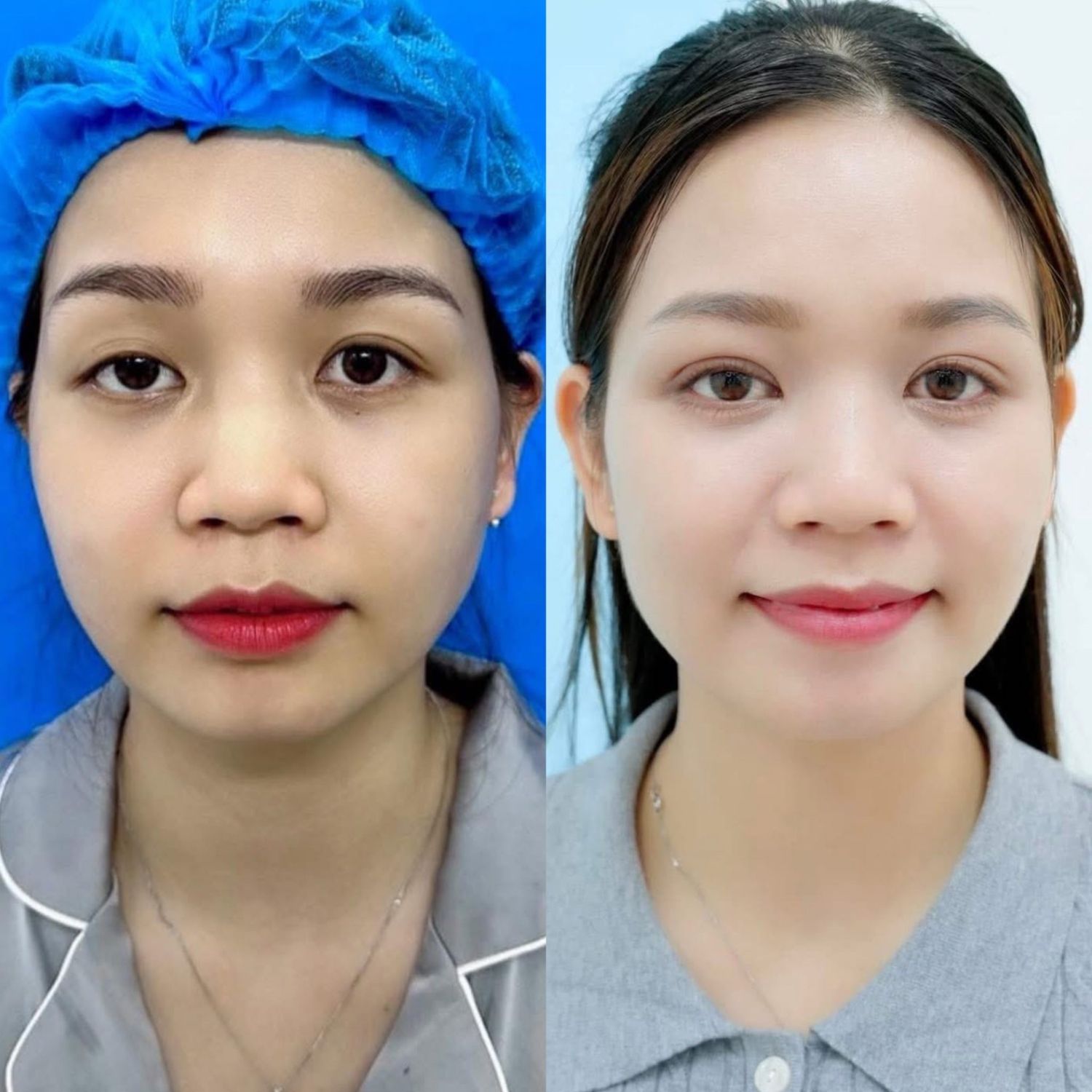 Sửa mí cân đối, đẹp tự nhiên