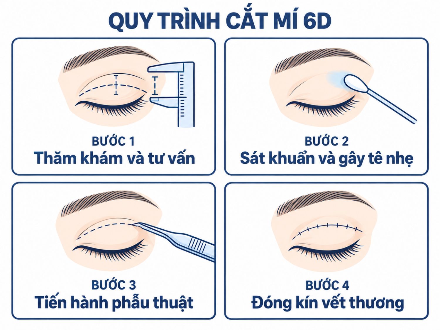 ảnh mô tả Quy trình thực hiện cắt mí 6D chuẩn y khoa