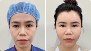 Cắt mí ở đâu đẹp tại TP.HCM? 5 tiêu chí quan trọng để chọn đúng địa chỉ uy tín