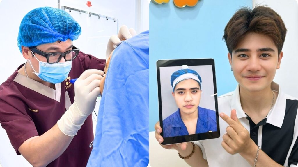 Cắt mí tại Kangnam Hà Nội – Kiến tạo mắt hai mí tự nhiên, an toàn