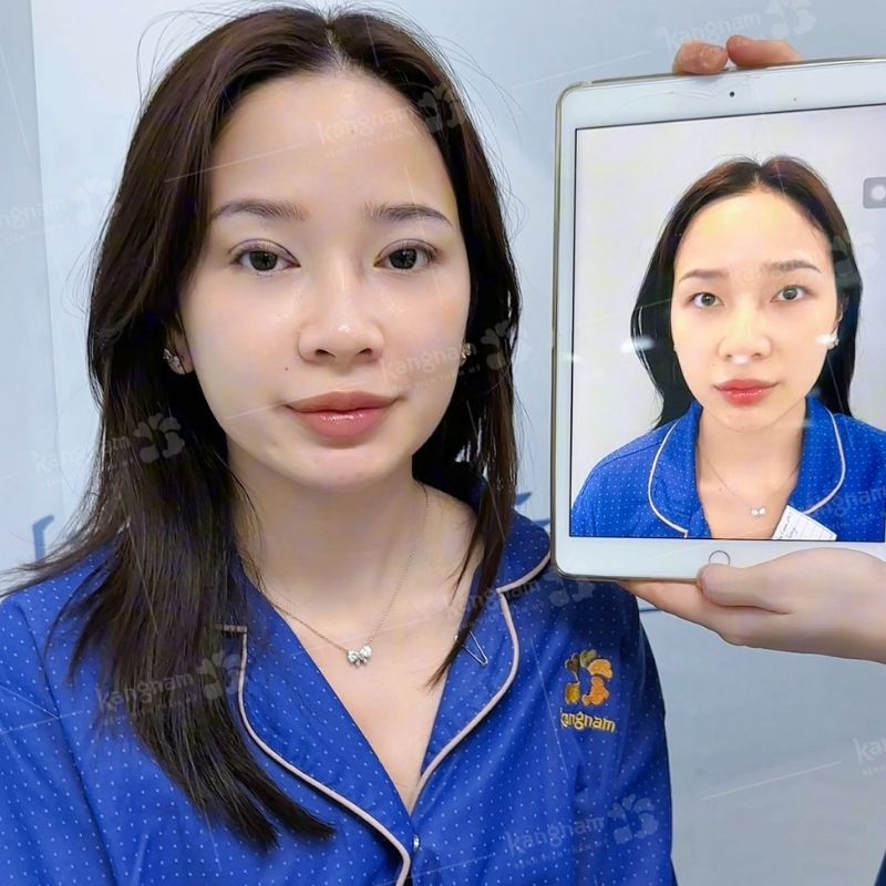 Nếp mí rõ ràng, tự nhiên