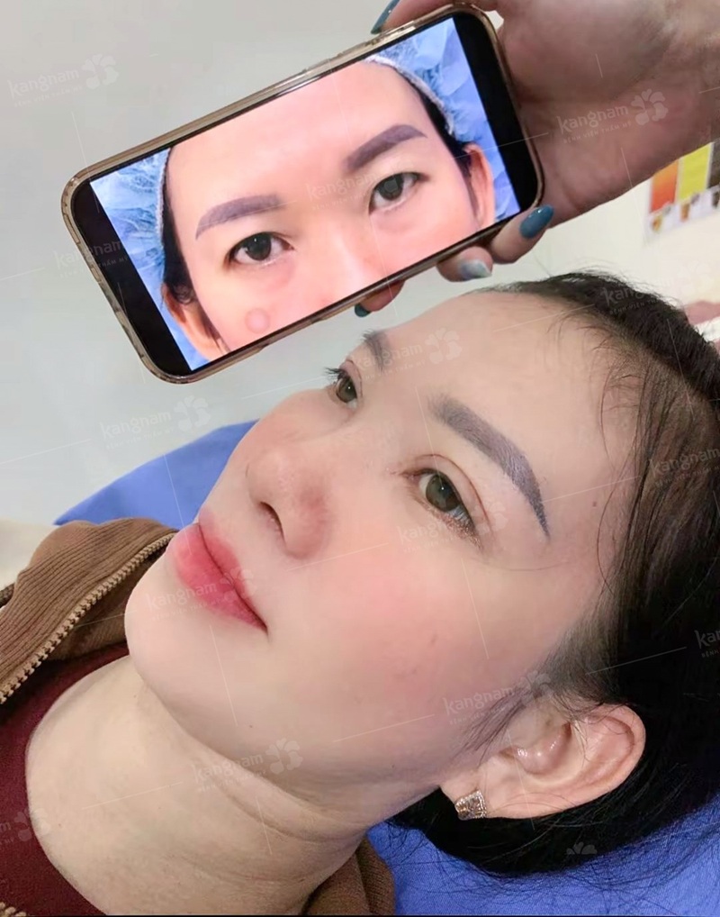 Cắt mí Plasma Hàn Quốc tái tạo nếp mí đẹp, sắc nét