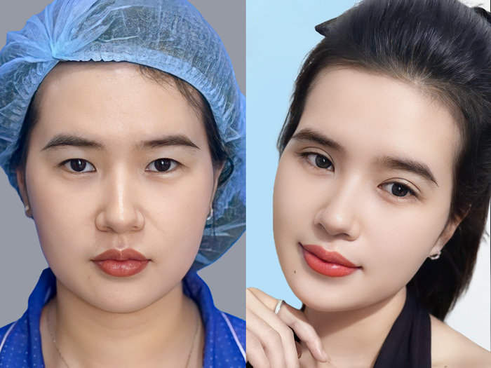 ảnh so sánh khách hàng sau khi cắt mí, gương mặt vẫn giữ được các nét đặc trưng riêng biệt
