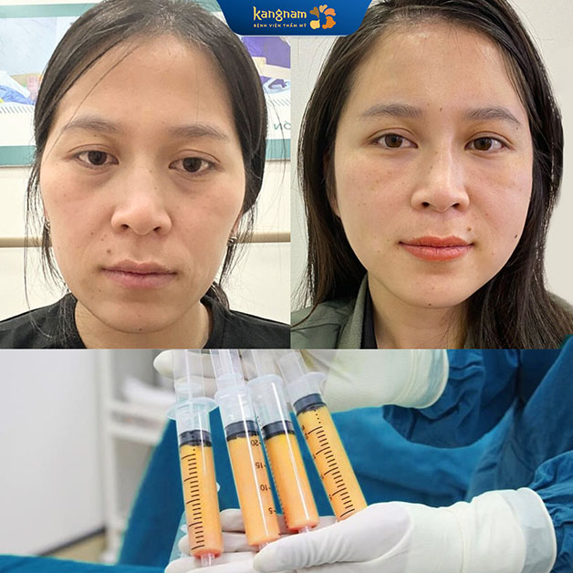 Vùng cấy mỡ ổn định, tự nhiên