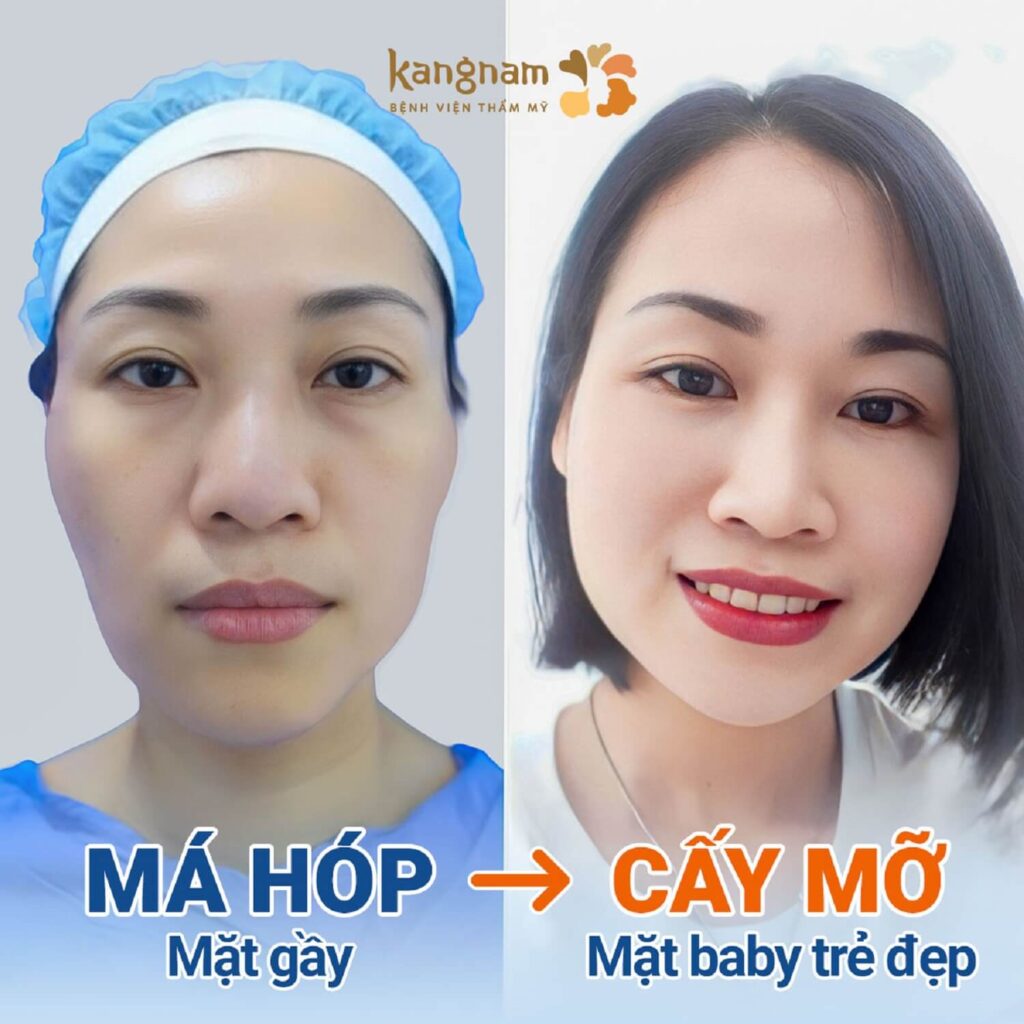 Cấy mỡ khắc phục tình trạng má hóp, hốc hác