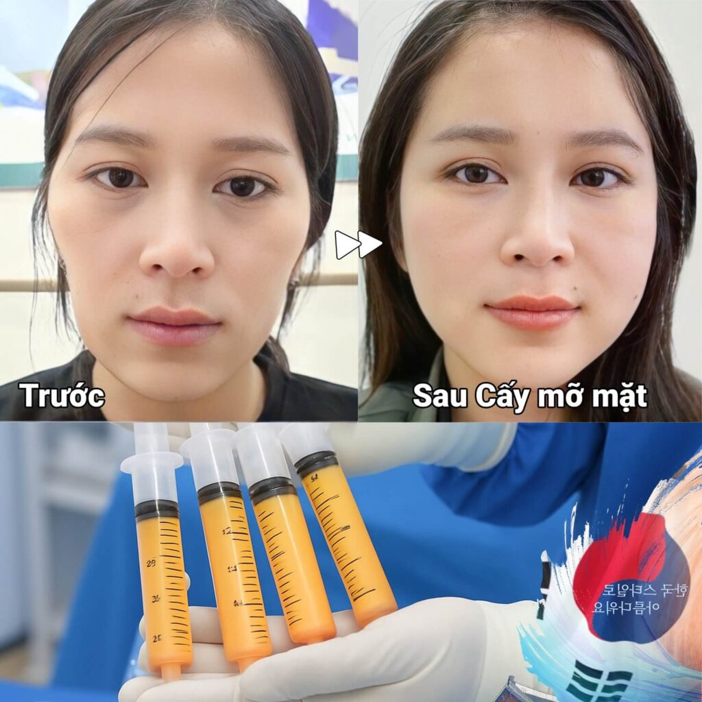 Khách hàng sở hữu khuôn mặt cân đối, hài hòa sau cấy mỡ