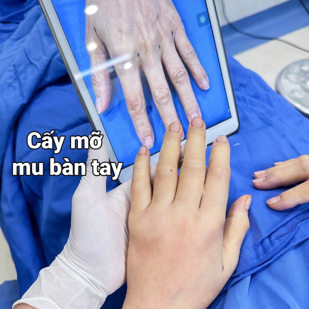 Nên cấy mỡ tại những đơn vị uy tín, chất lượng cao