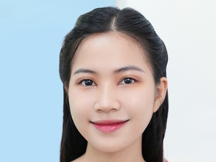 Nếp mí hoàn thiện, rõ nét và tự nhiên hơn