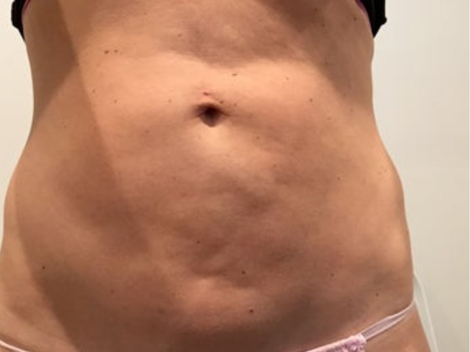 Vùng da sau hút mỡ bị lồi lõm