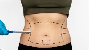 Chi phí hút mỡ bao nhiêu? Bảng giá hút mỡ từng vùng cụ thể