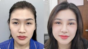 Chi phí nâng mũi giá bao nhiêu