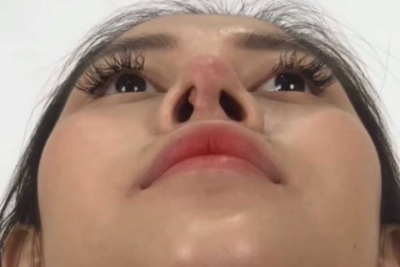 Ham rẻ lựa chọn cơ sở nâng mũi không uy tín dẫn đến biến chứng