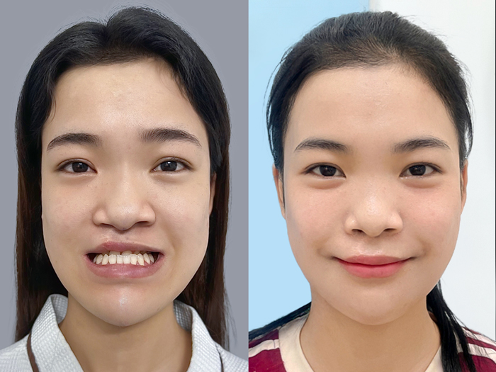 khách hàng sau khi chỉnh hàm lệch có gương mặt cân đối