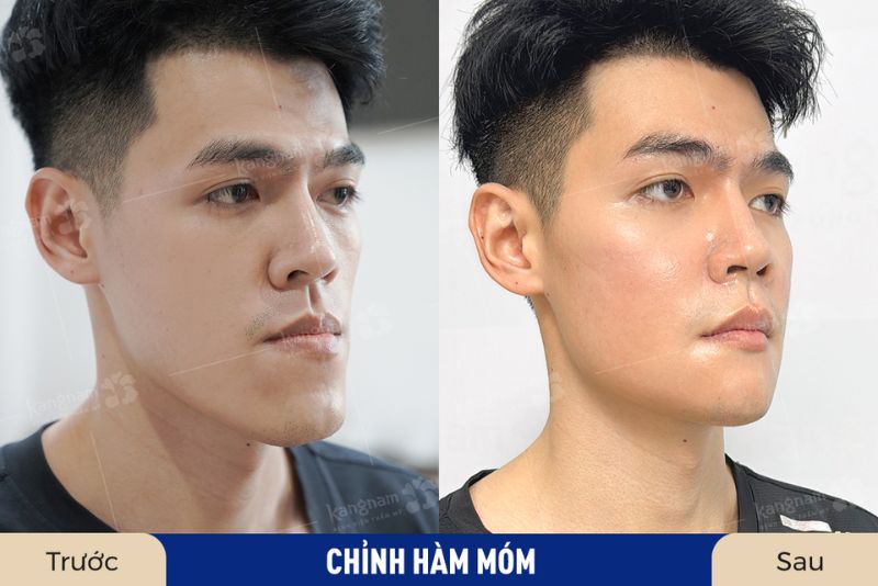 Ca hàm móm thành công cho khách nam