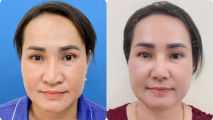 Chỉnh sửa mũi sau nâng mũi: Thời điểm ‘vàng’ và cách xử lý phù hợp