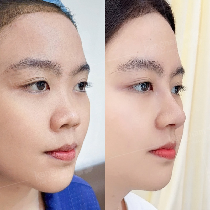 Chuẩn bị kỹ trước nâng mũi giúp đảm bảo an toàn