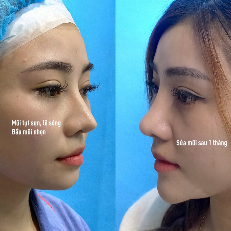 Việc làm mũi sẽ phụ thuộc vào nhu cầu của bản thân