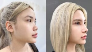 có nên làm mũi không