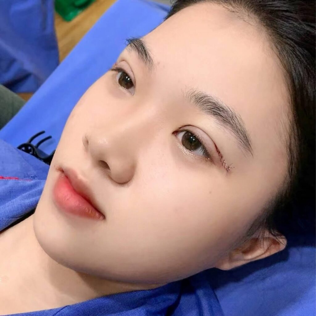 Sau khi cắt mí, vết thương sẽ sưng tấy, bầm tím