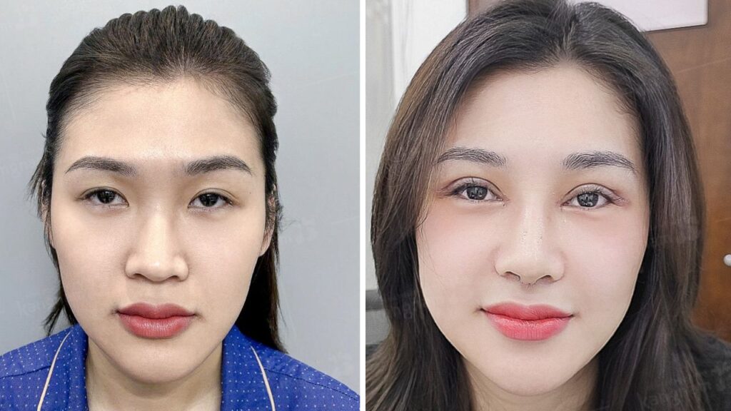 Dấu hiệu bình thường sau nâng mũi: Cách nhận biết để không hoang mang