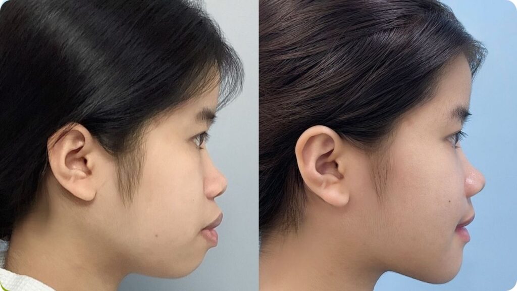 Độn cằm ở đâu đẹp tại Sài Gòn? Cách chọn địa chỉ phù hợp