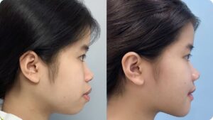 Độn cằm ở đâu đẹp tại Sài Gòn? Cách chọn địa chỉ phù hợp