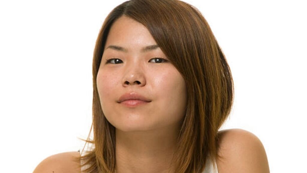 Độn cằm tròn là gì? Phương pháp thực hiện, độ bền và chi phí