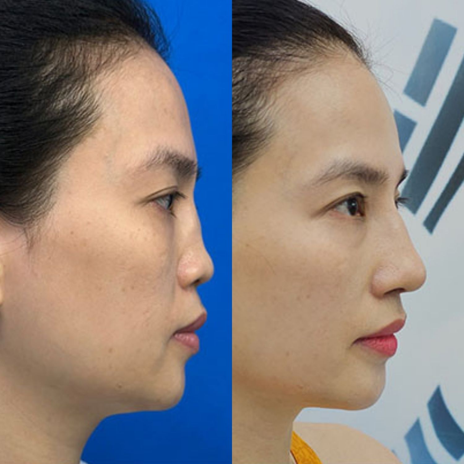 Đã từng nâng mũi nhiều lần không nên tiêm filler nữa