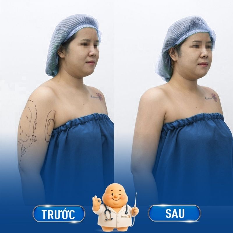 Loại bỏ mỡ bắp tay chỉ trong tíc tắc