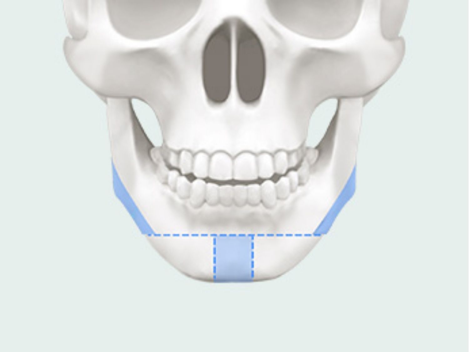 mô phỏng các bị trí có thể bị tác động khi gọt hàm