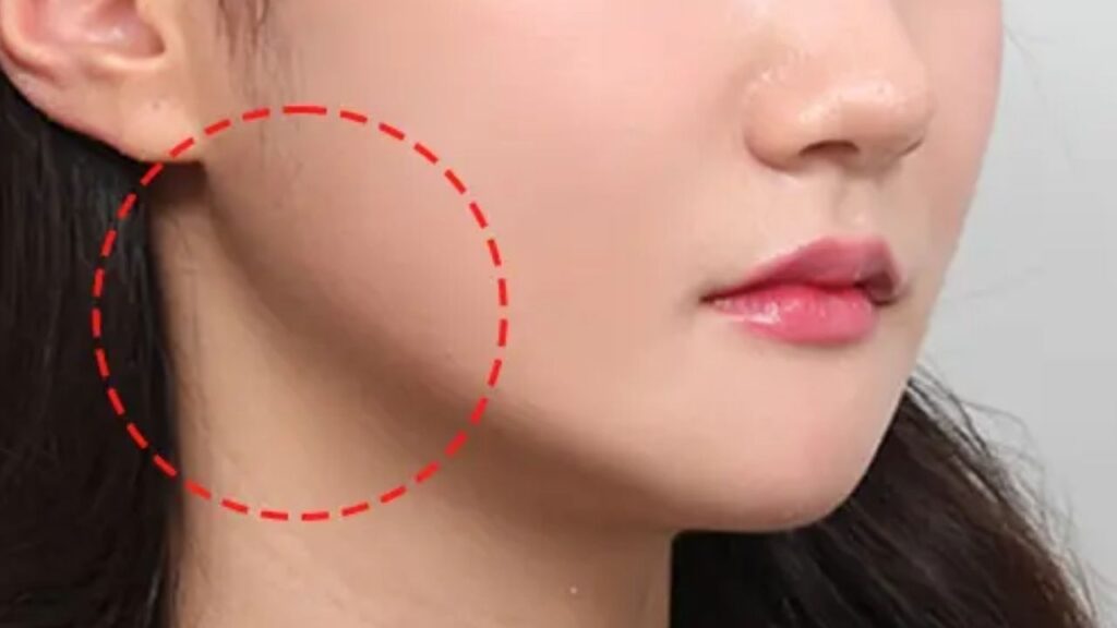 Gọt hàm có vĩnh viễn không? Sự thực về khả năng tái tạo xương và độ bền kết quả