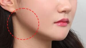 Gọt hàm có vĩnh viễn không? Giải đáp từ góc độ y khoa