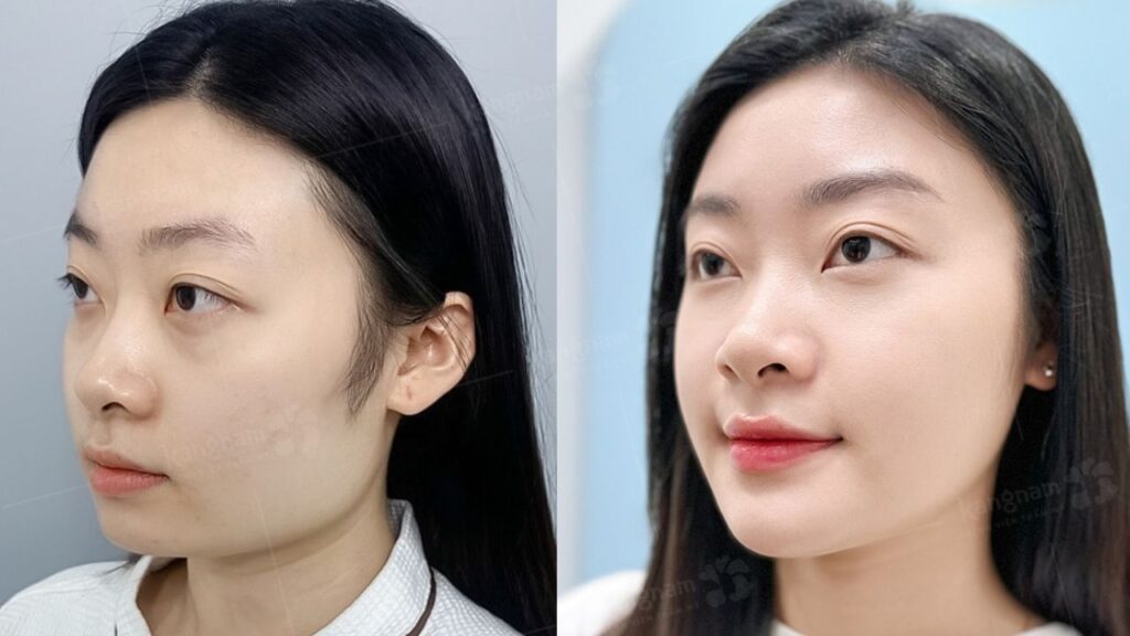 Gọt hàm ở đâu đẹp? Người Sài Gòn thường đánh giá dựa trên tiêu chí nào?