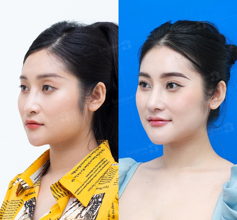 Gọt hàm Vline giúp thon gọn 